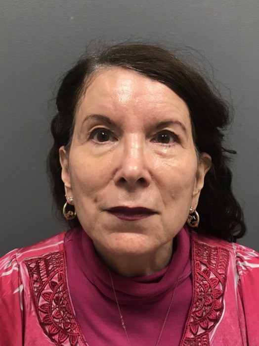 Tox--amp--Filler | After Non Surgical