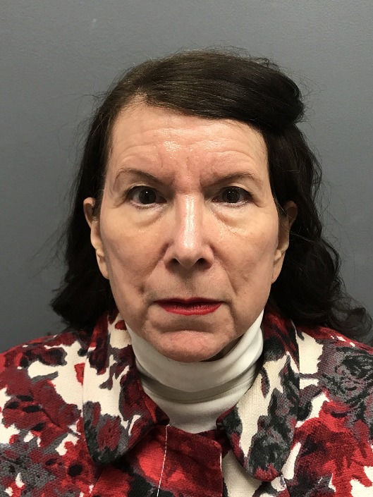 Tox--amp--Filler | Before Non Surgical