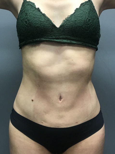 Liposuction-Patient-4 | After Liposuction