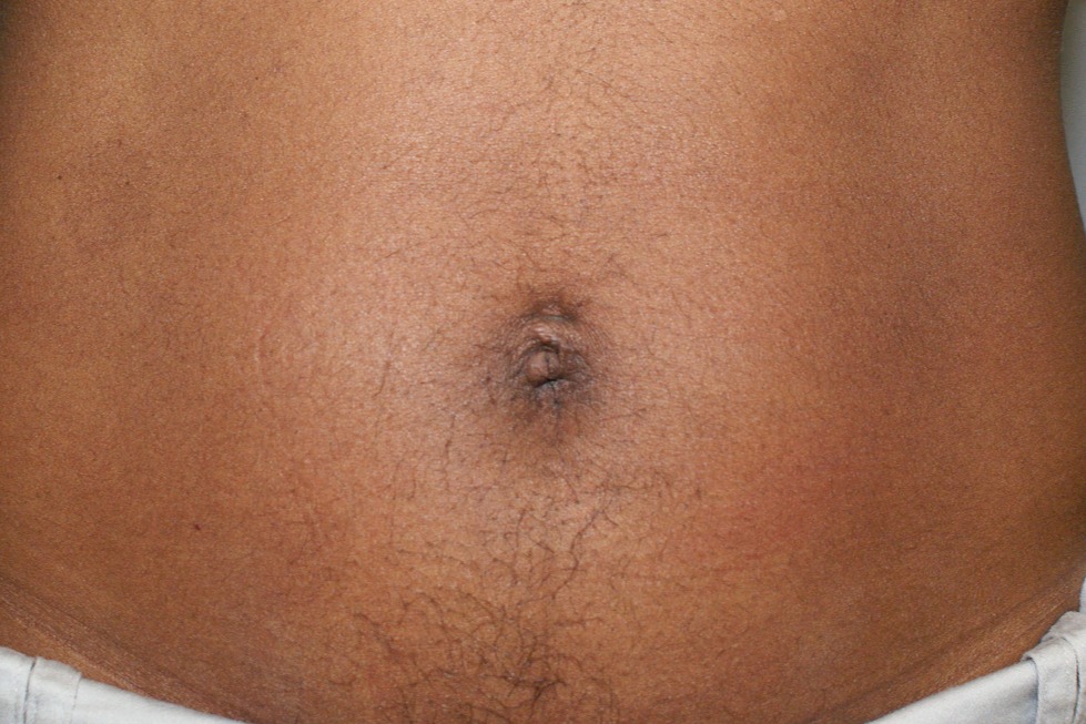 Umbilicoplasty-Patient-3 | After Belly Button Surgery