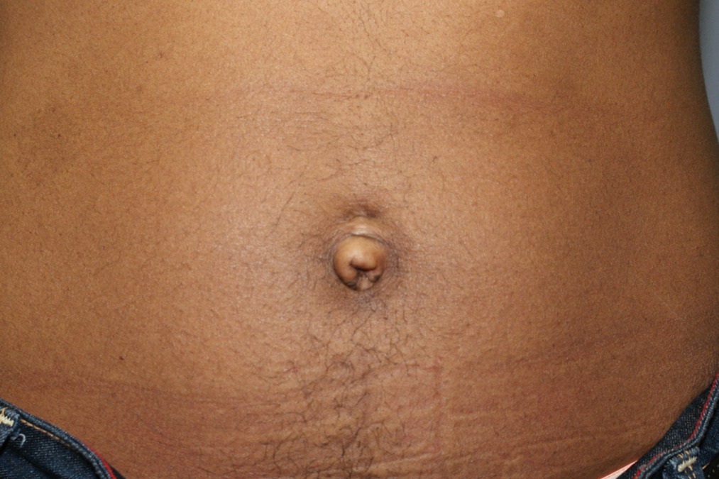 Umbilicoplasty-Patient-3 | Before Belly Button Surgery