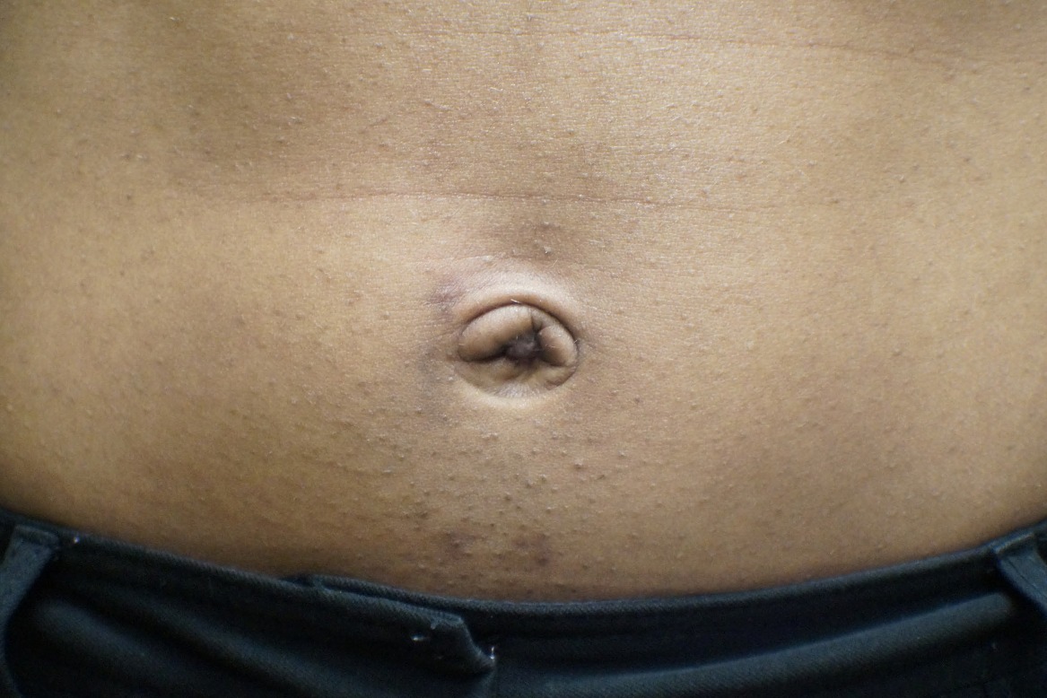 Umbilicoplasty-Patient-4 | After Belly Button Surgery