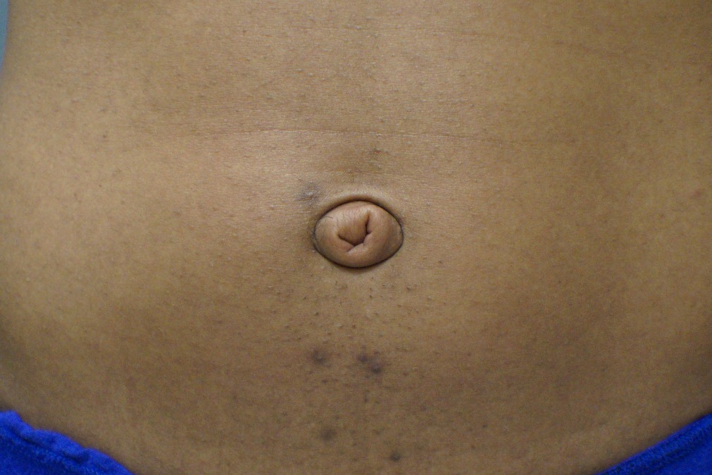 Umbilicoplasty-Patient-4 | Before Belly Button Surgery