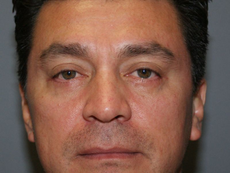 Lower eyelid surgery 5553 post