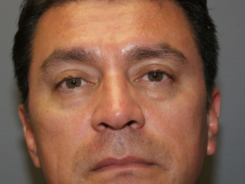 Lower eyelid surgery 5553 pre