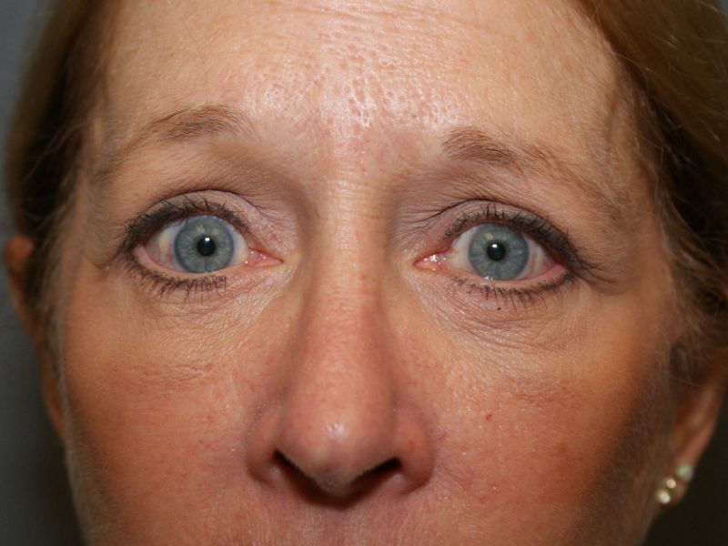 eyelid surgery 4267 post