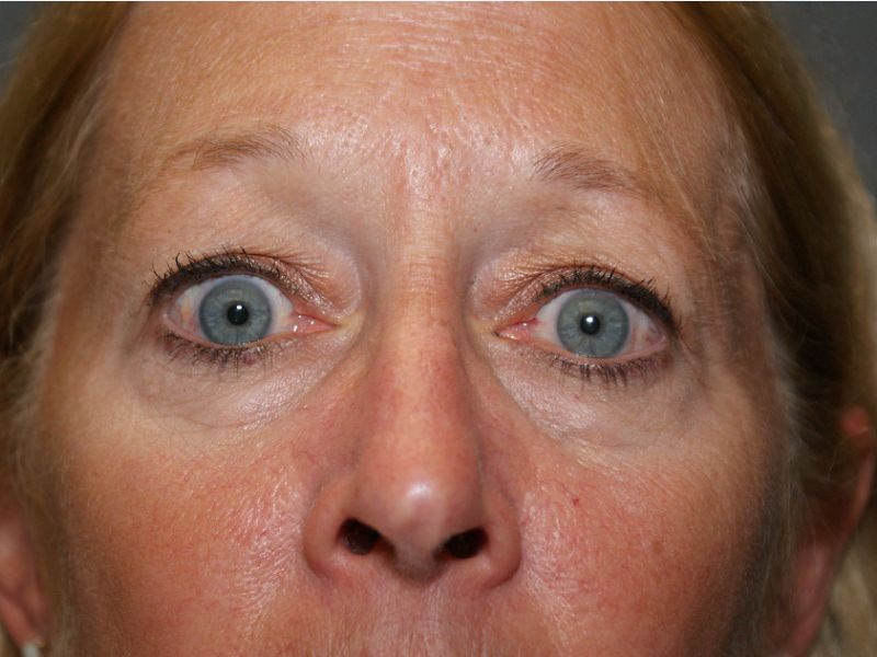 eyelid surgery 4267 pre