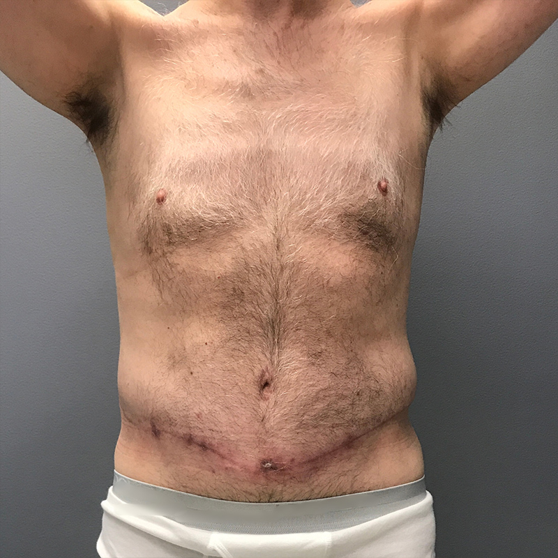 Body-Lift-Patient-01 | After Body Lift