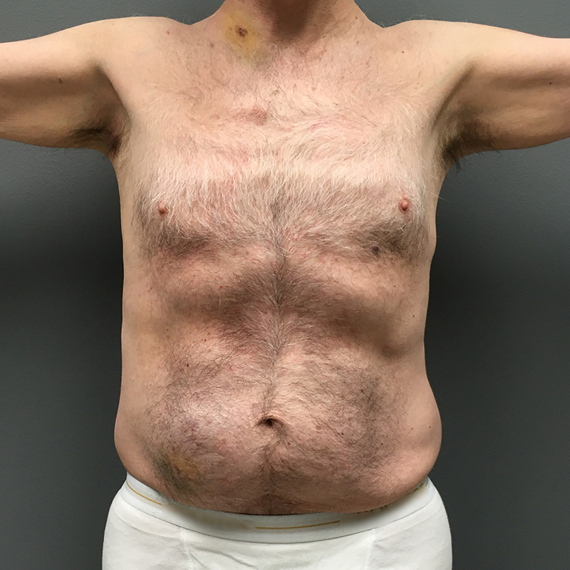 Body-Lift-Patient-01 | Before Body Lift