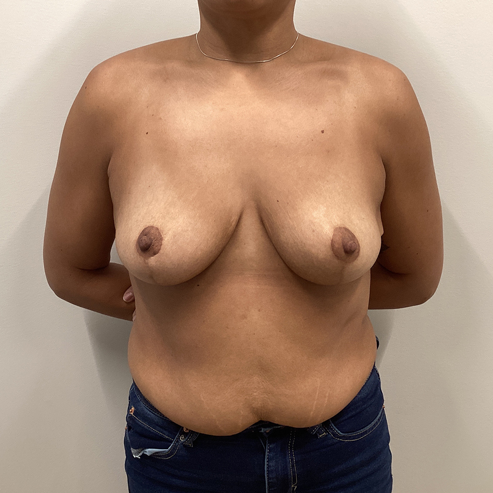 Case--6652 | After Breast Reduction