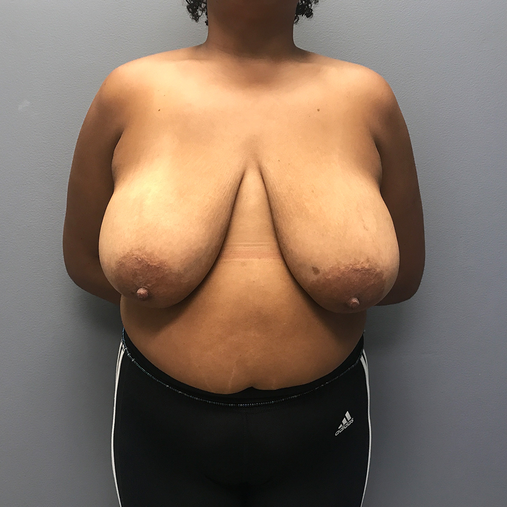 Case--6652 | Before Breast Reduction