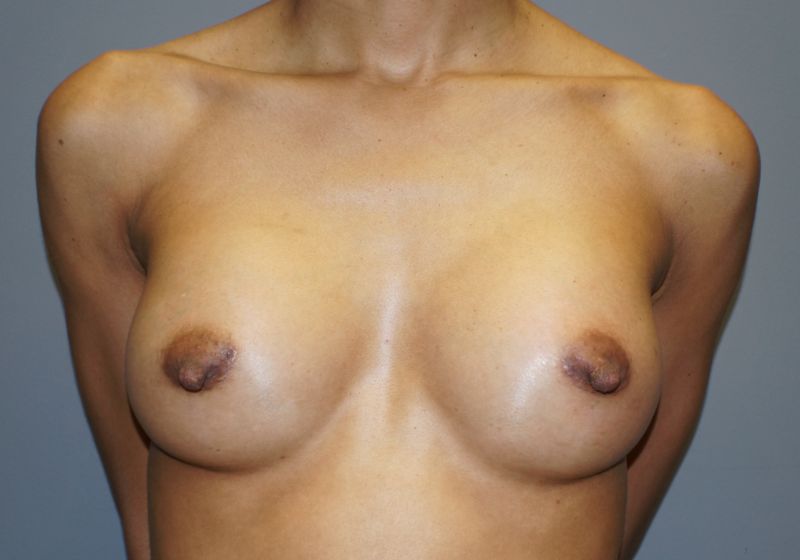 10590 Breast Augmentation Post