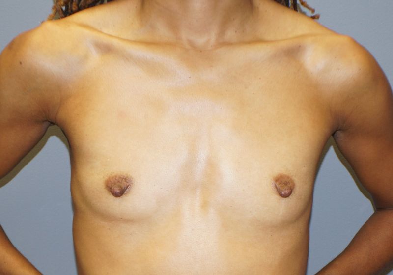 10590 Breast Augmentation Pre