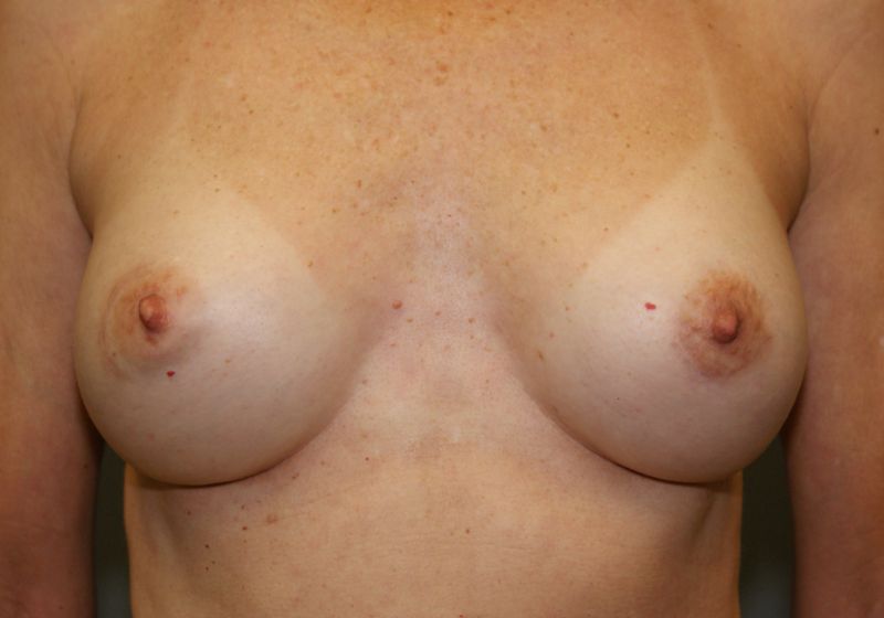 Breast Augmentation 1142 Post