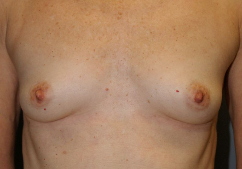 Breast Augmentation 1142 Pre