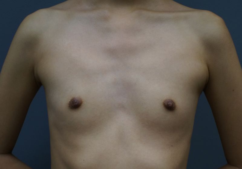 11493 Breast Augmentation Oblique Pre