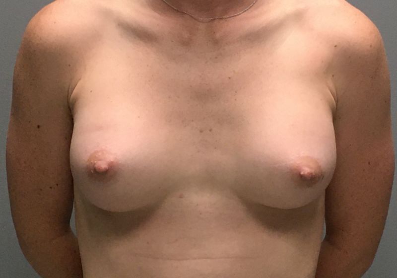 13491 Breast Augmentation Post