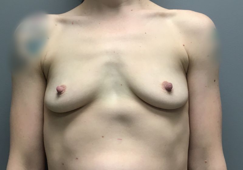 14381 Breast Augmentation Pre