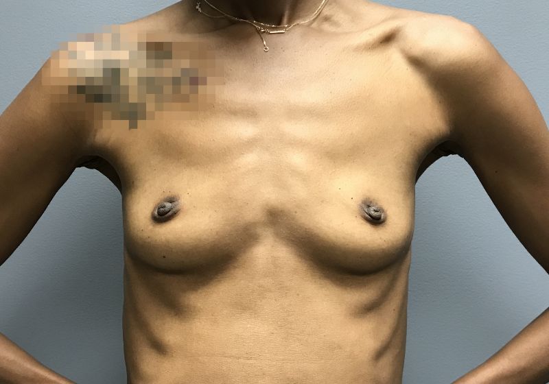 15504 Breast Augmentation Pre
