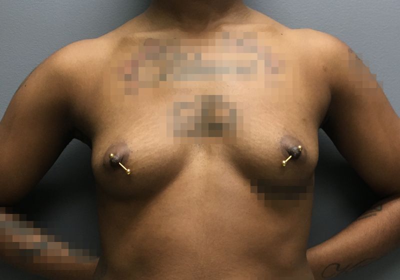 16486 Breast Augmentation Pre