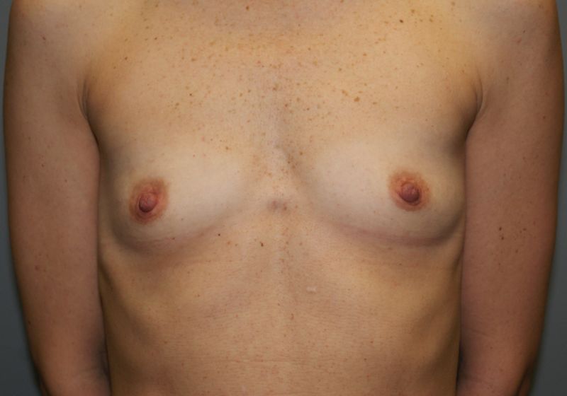 Breast Augmentation 2832 Pre