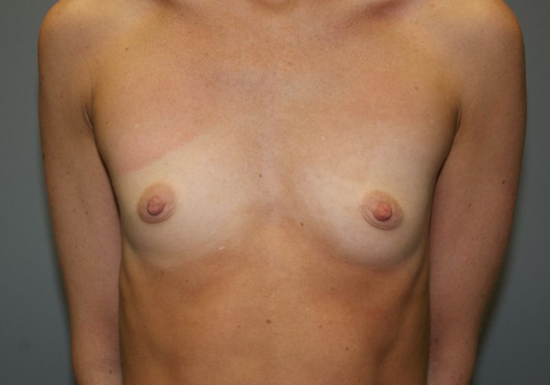 Breast Augmentation 3118 Pre