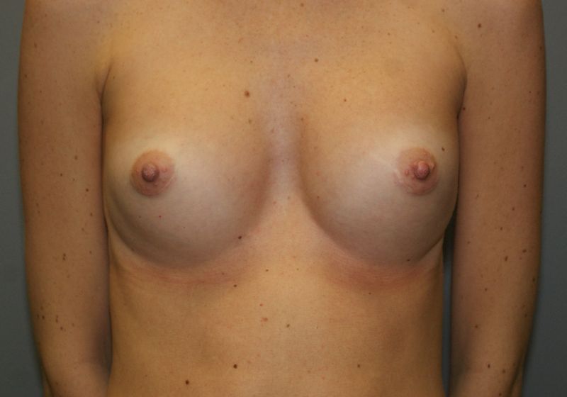 Breast Augmentation 4073 Post