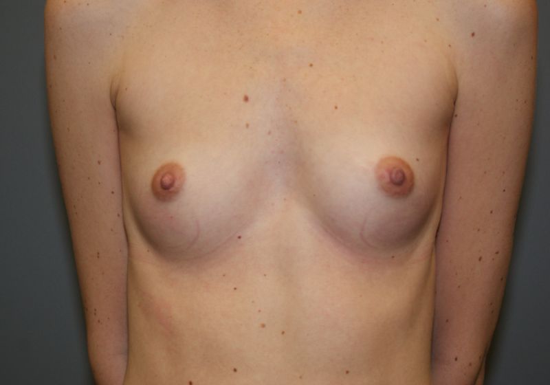Breast Augmentation 4073 Pre