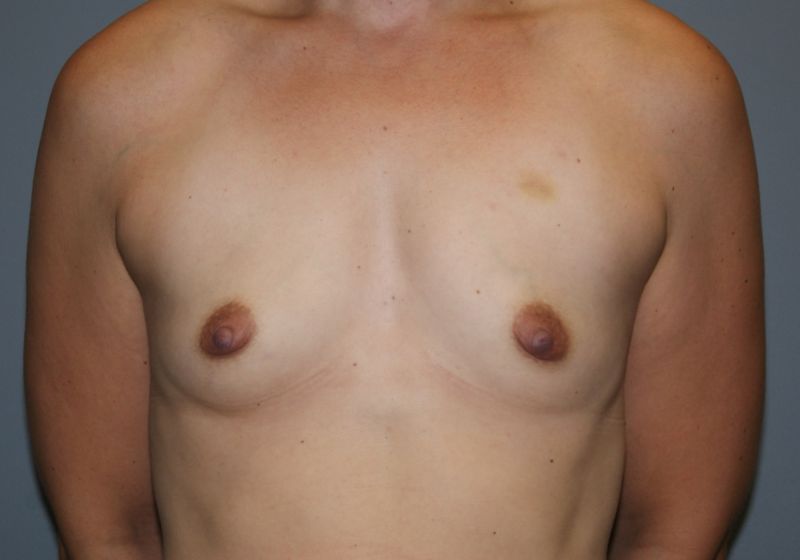 Breast Augmentation 4525 Pre