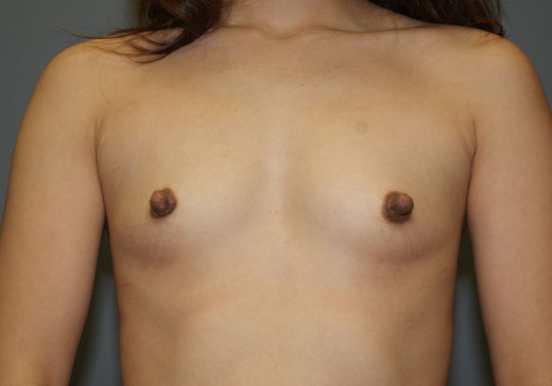 Breast Augmentation 4892 Pre