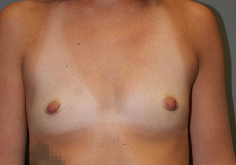 Breast Augmentation 5127 Pre