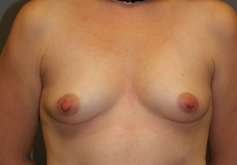 5608 Breast Augmentation Pre