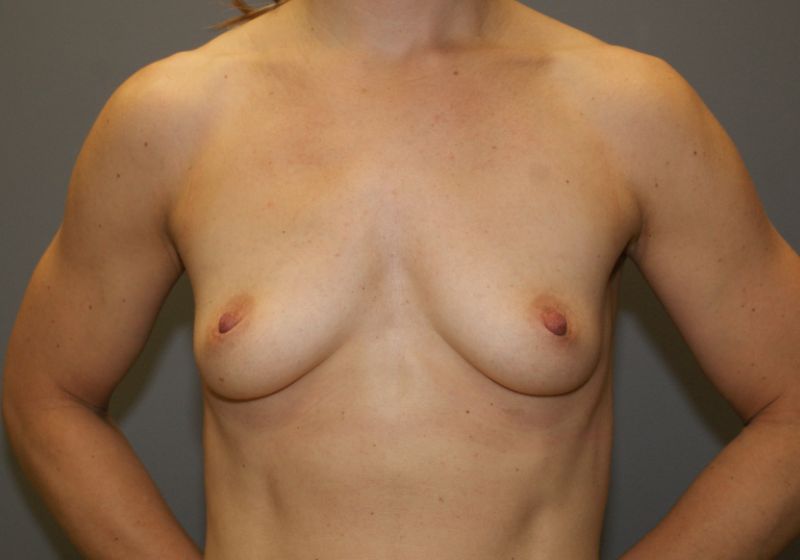 6308 Breast Augmentation Pre