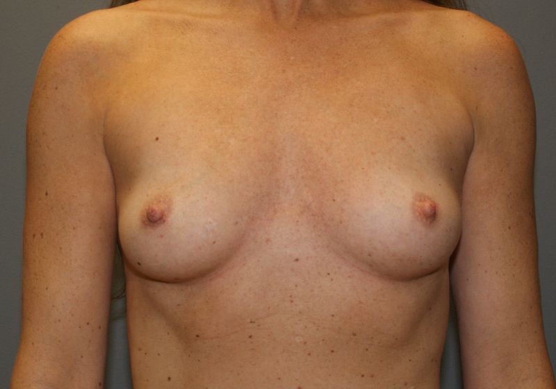 7369 Breast Augmentation Pre