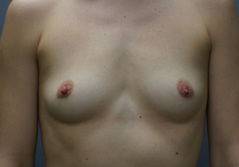 9578 Breast Augmentation Pre