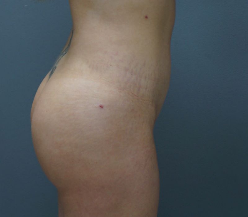 Butt Augmentation 7522 Post