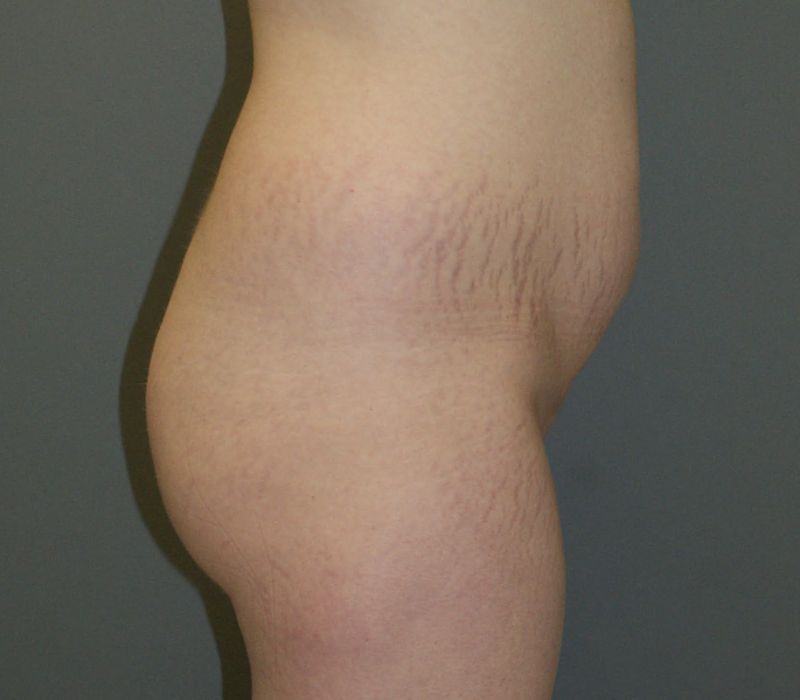 Butt Augmentation 7522 Pre