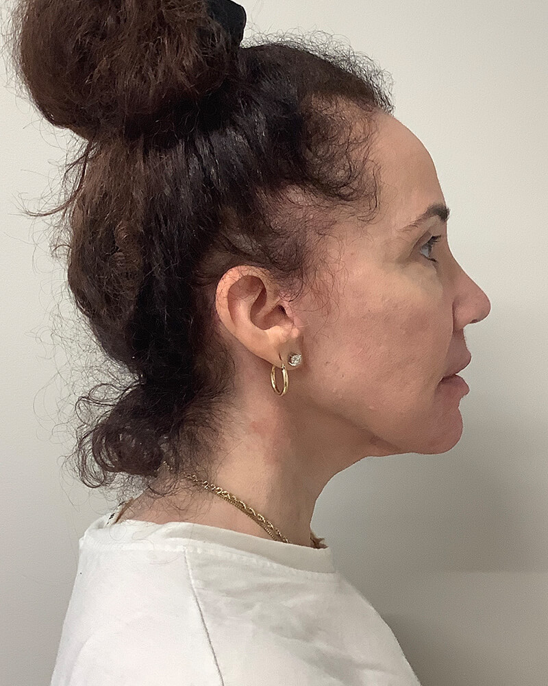 Case--2786 | After Facelift