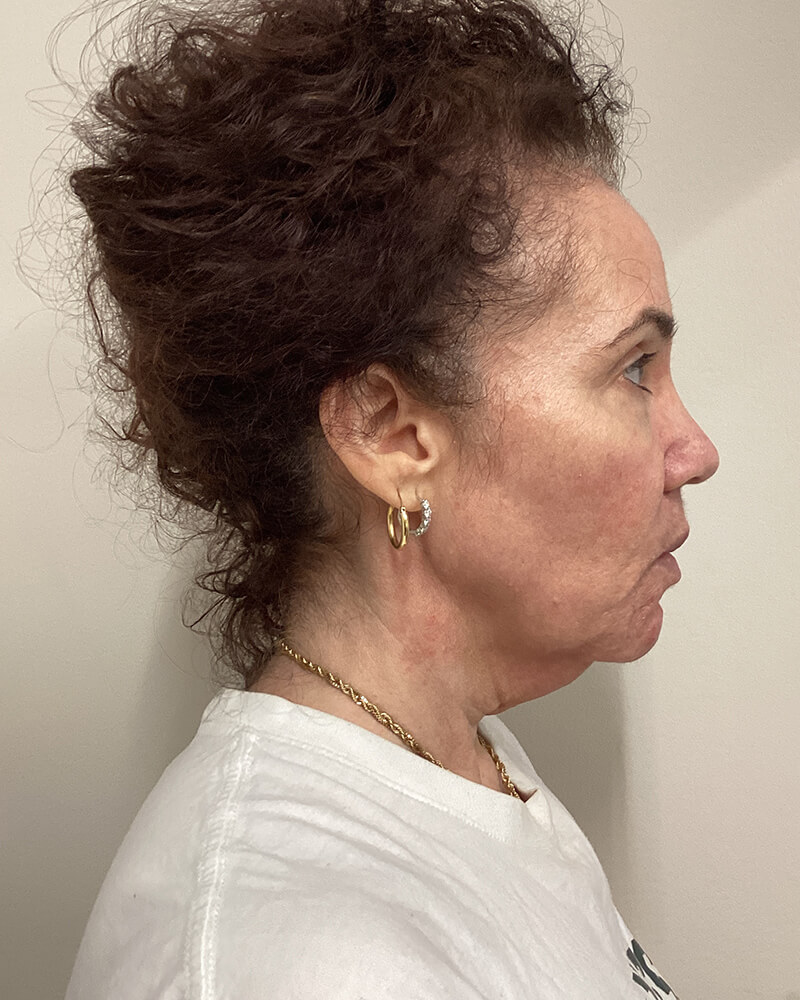 Case--2786 | Before Facelift