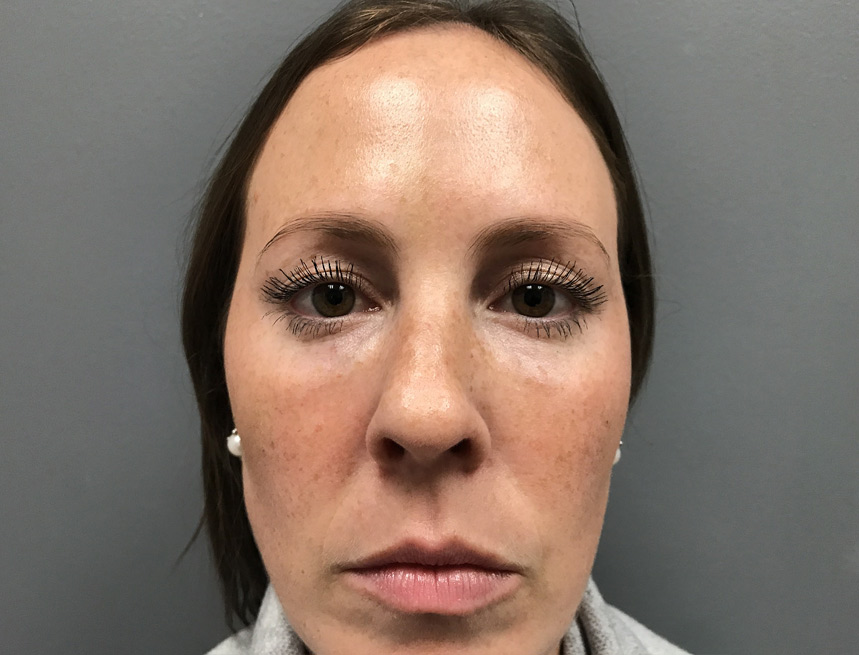 under eye filler after