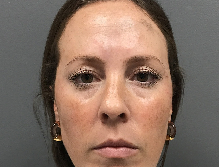 under eye filler before