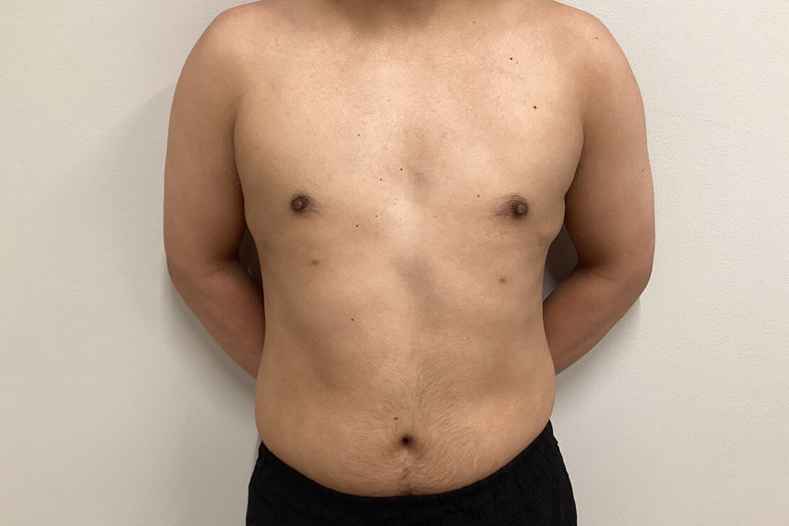 Case--7864 | After Gynecomastia