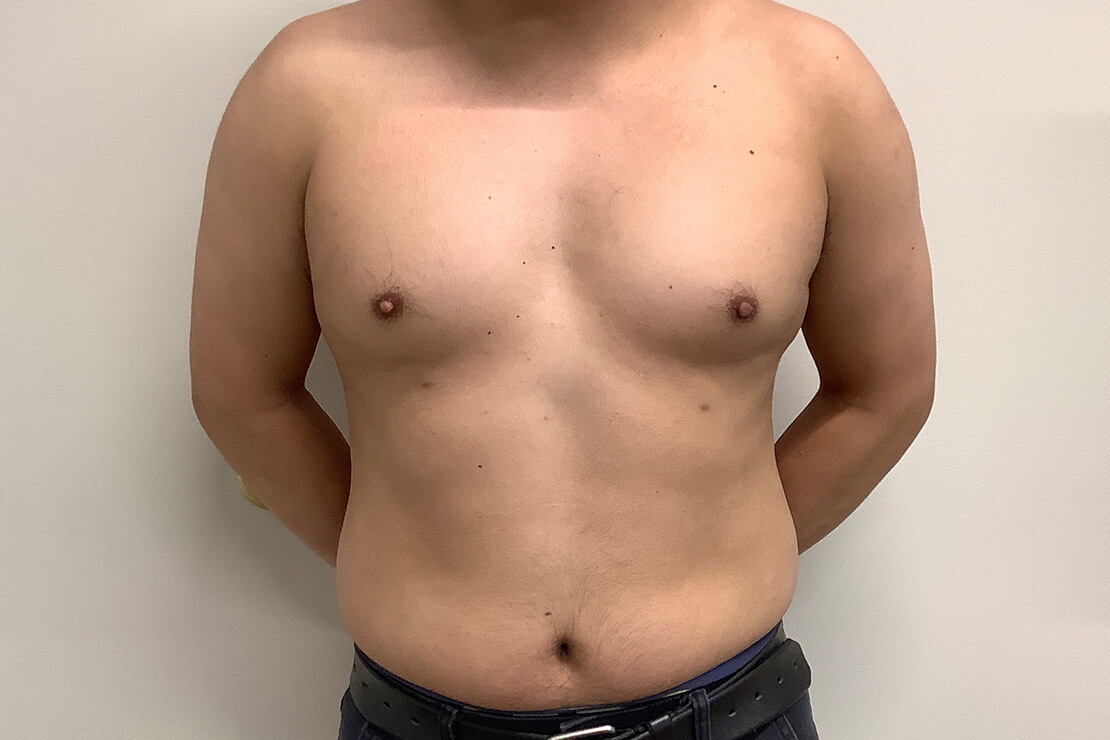 Case--7864 | Before Gynecomastia