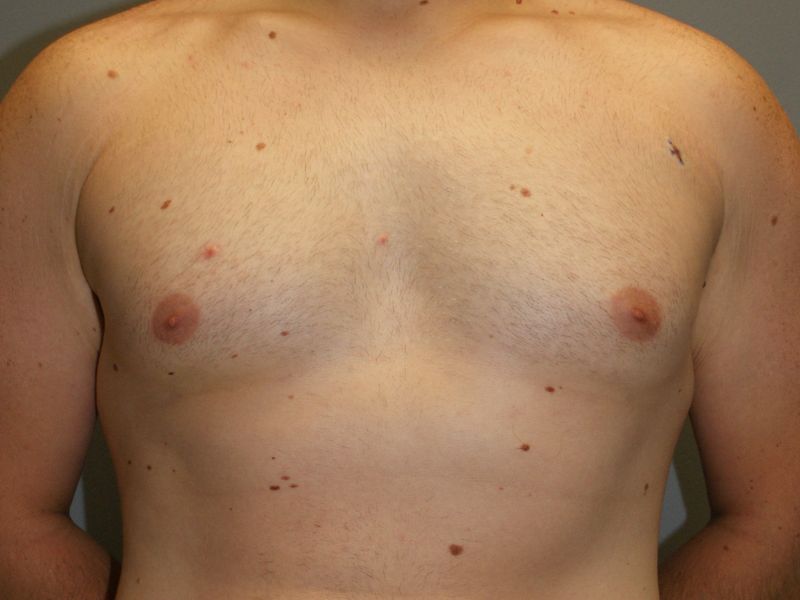 Gynecomastia 2506 Post
