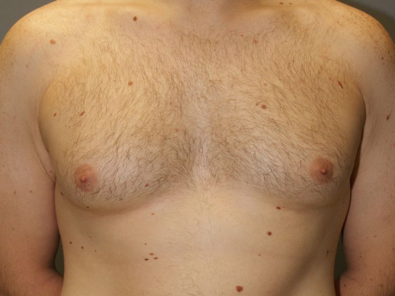 Gynecomastia 2506 Pre