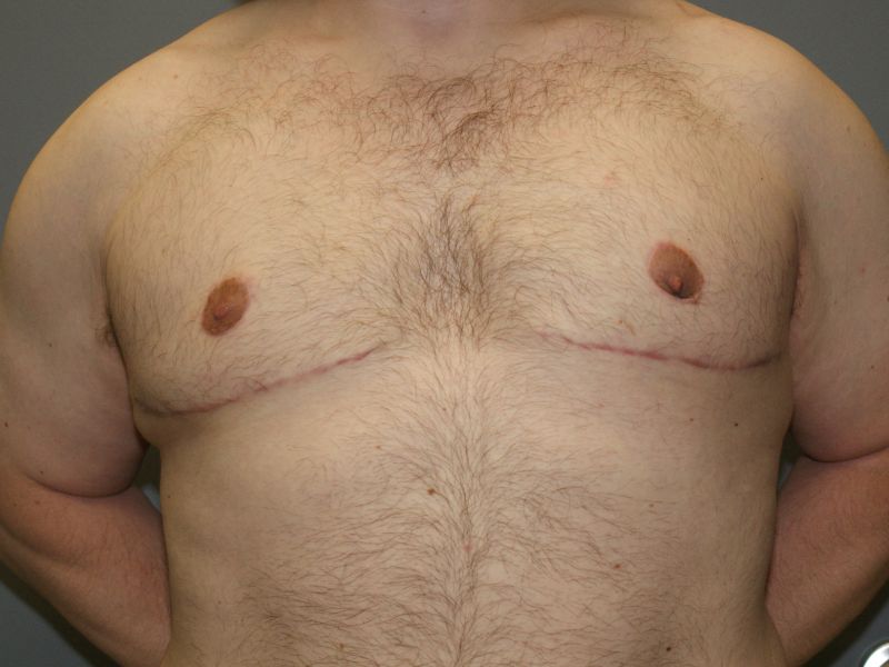 Gynecomastia 4628 Post