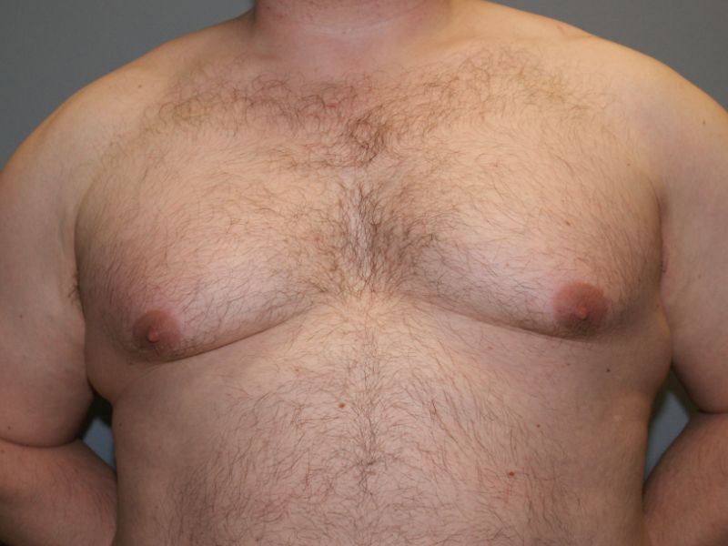 Gynecomastia 4628 Pre