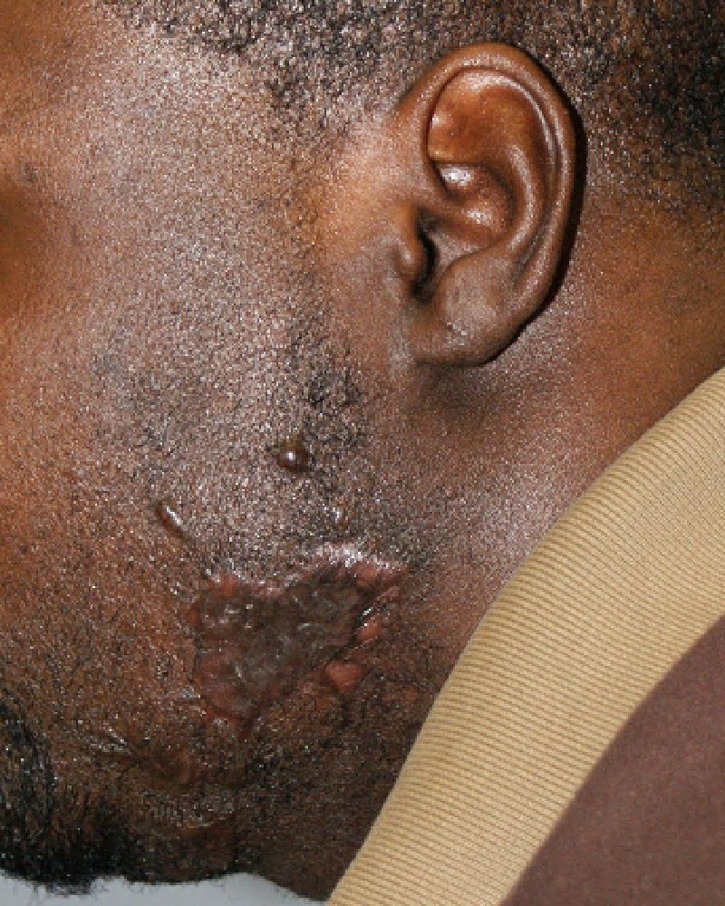 Keloid Scar Removal 2313 Post