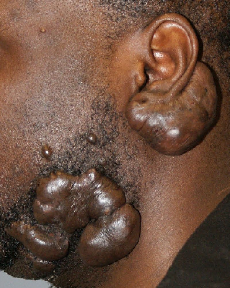 Keloid Scar Removal 2313 Pre