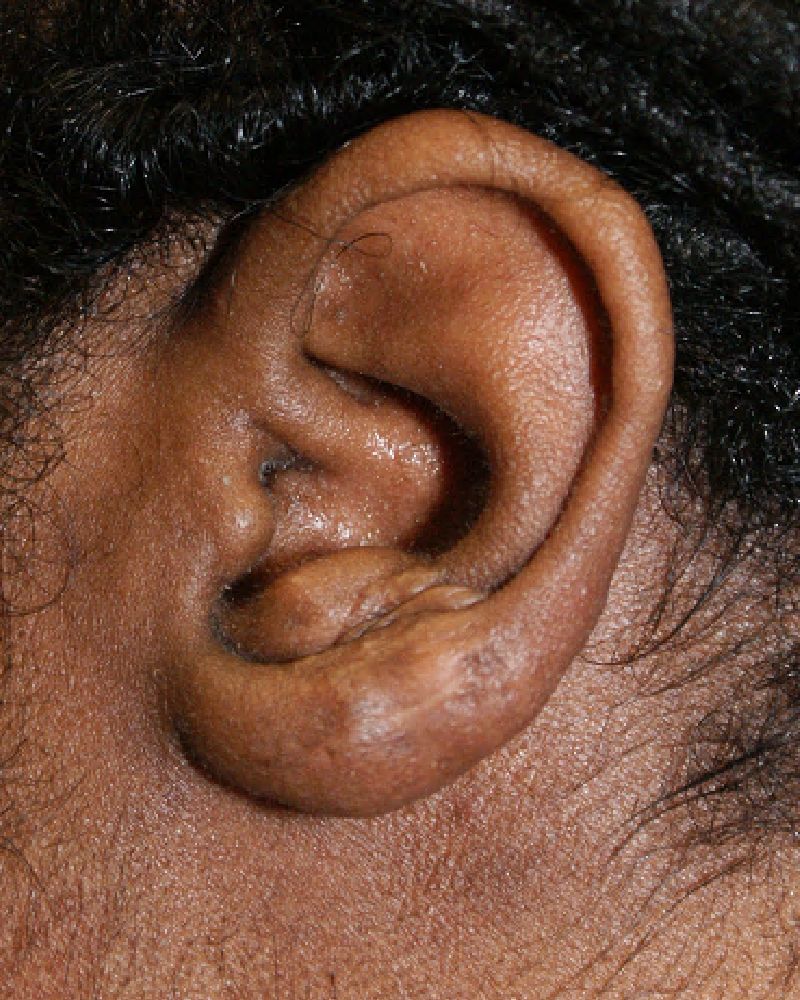 Keloid Scar Removal 2370 Post